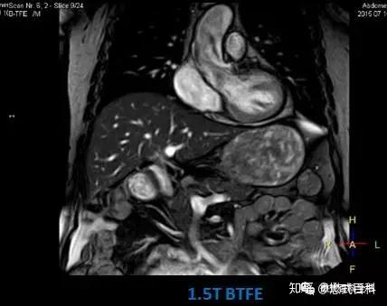 3 0t和1 5t磁共振扫描序列有哪些不同 知乎