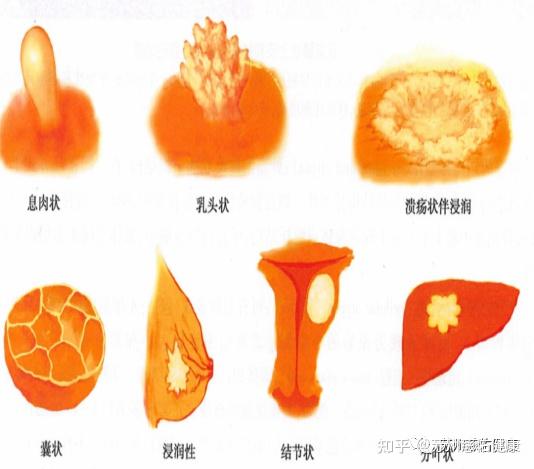 肿瘤是什么? - 知乎