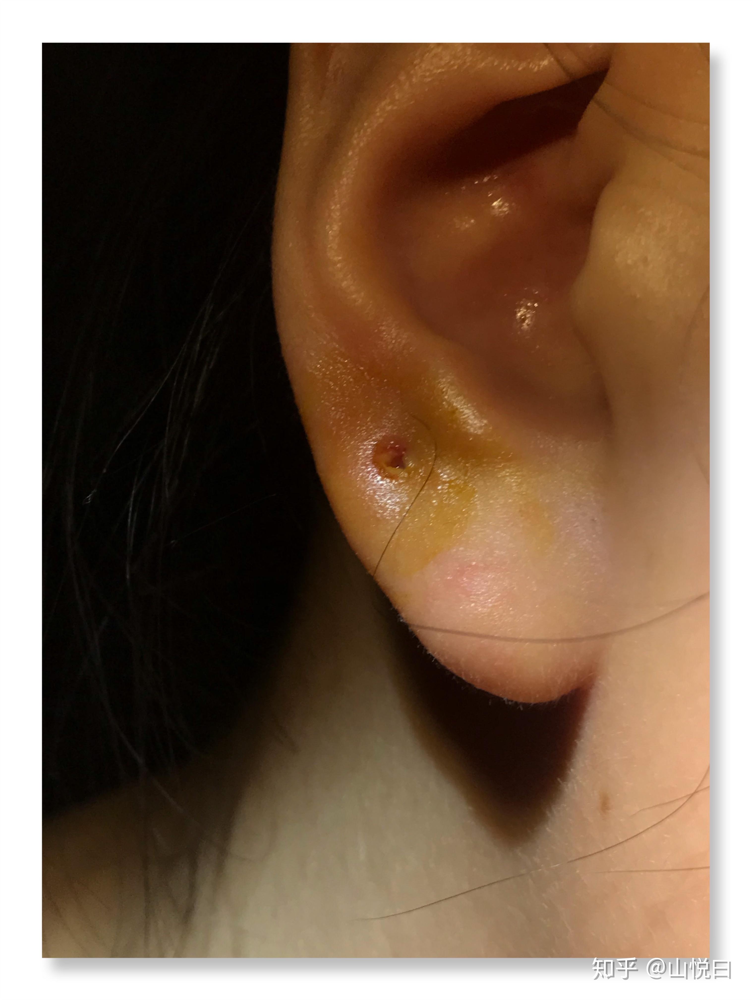 惨烈的激光打耳洞经历耳朵的阉割之旅