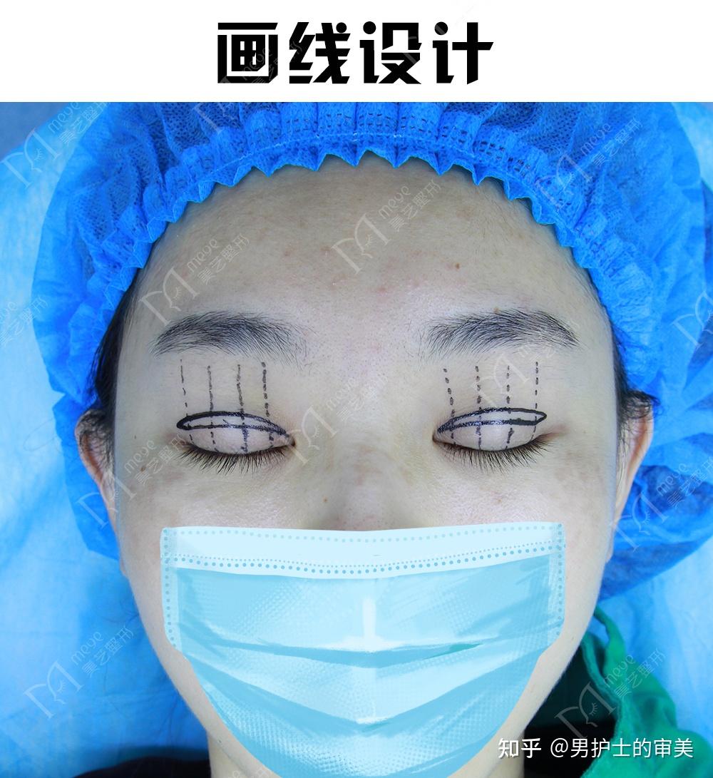 双眼皮设计