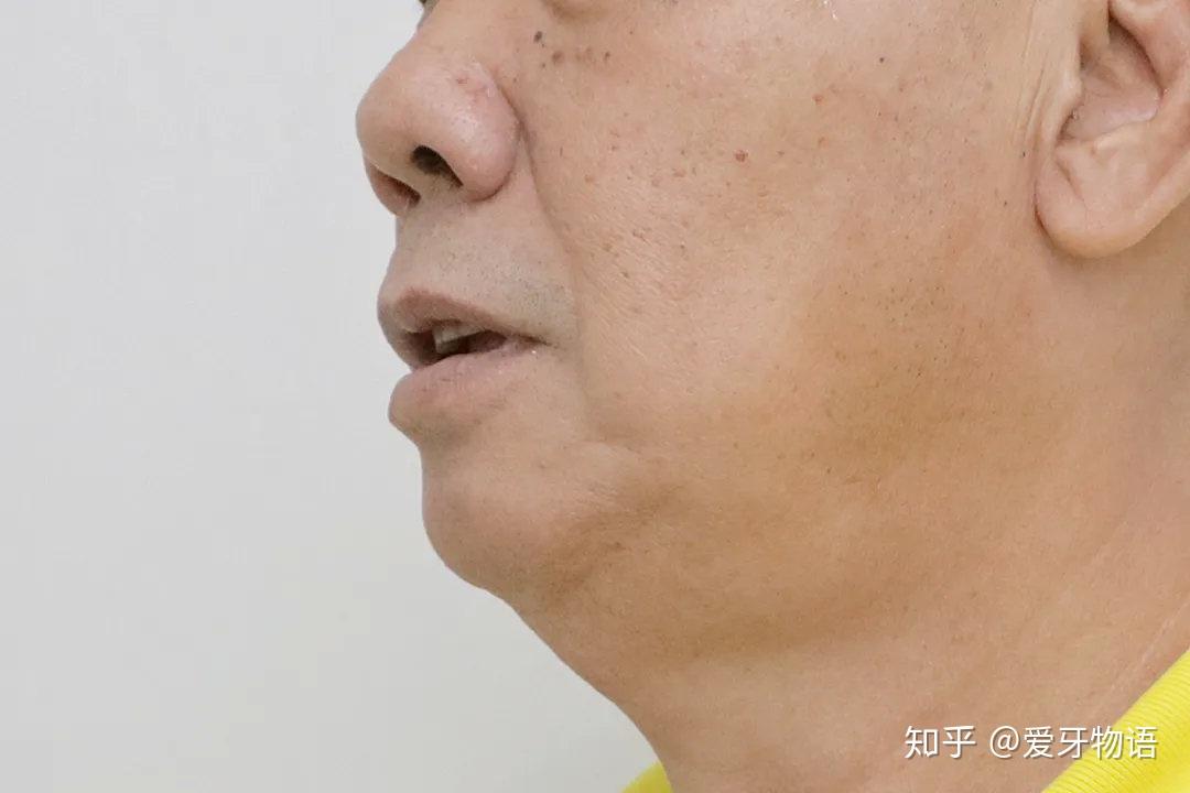 下颌牙齿多颗缺失,影响咀嚼以及发音