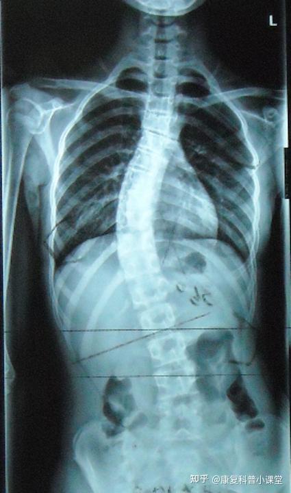 儿童脊椎骨侧弯曲图片图片
