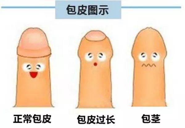 人家美国小孩儿一出生就割了,要是不割,包皮过长或包茎可是会