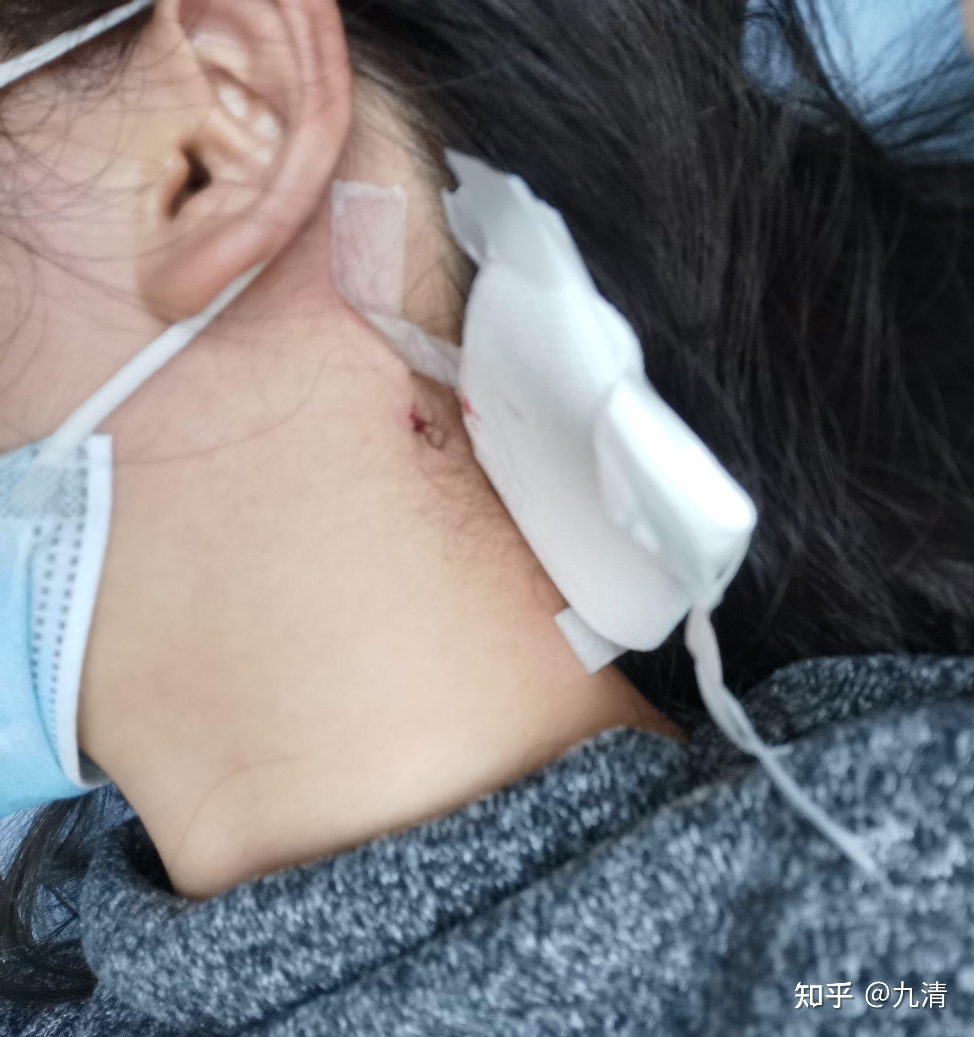 淋巴穿刺疼吗? - 知乎