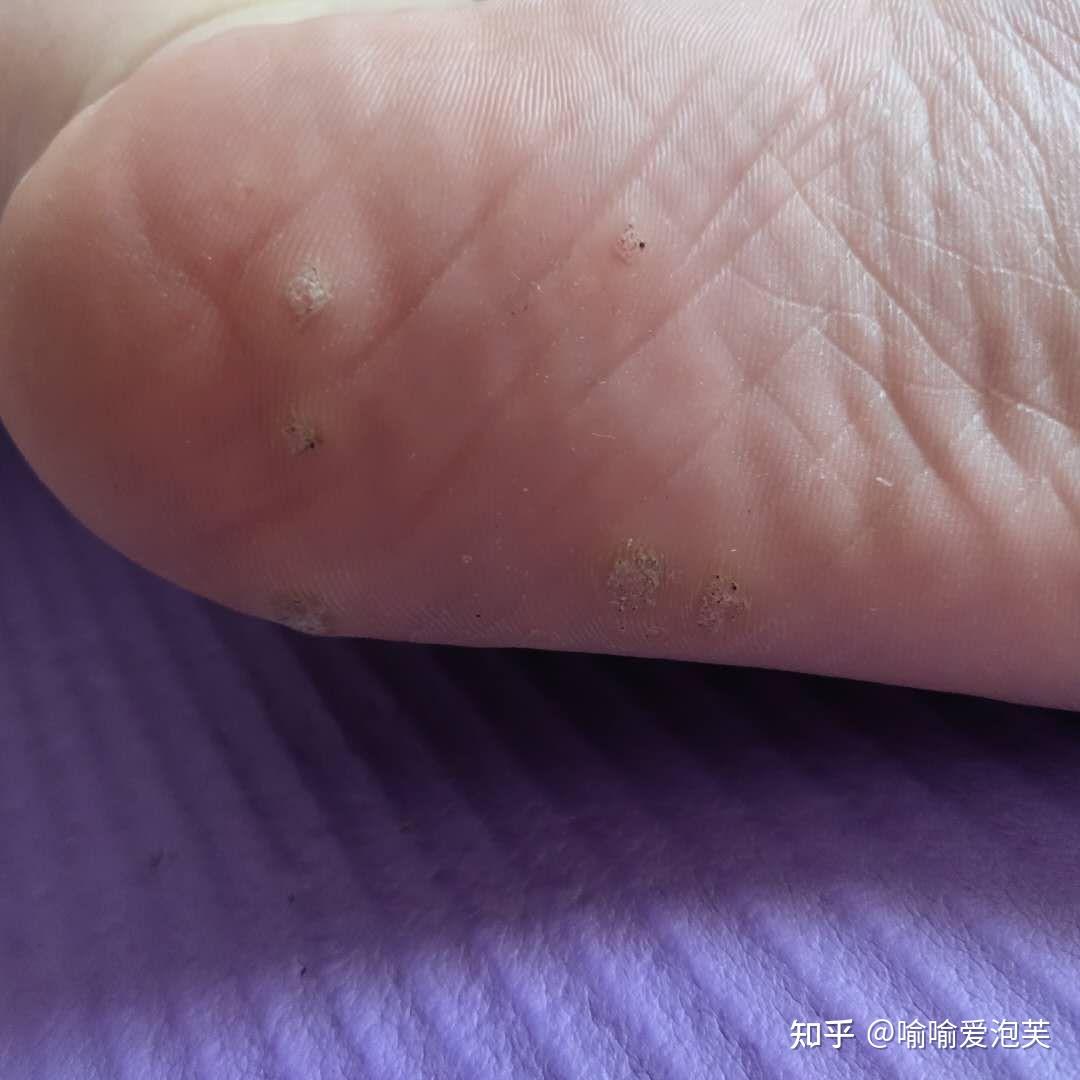 跖疣朋友们 冷冻 和打针治疗哪个疼啊 ? - 知乎