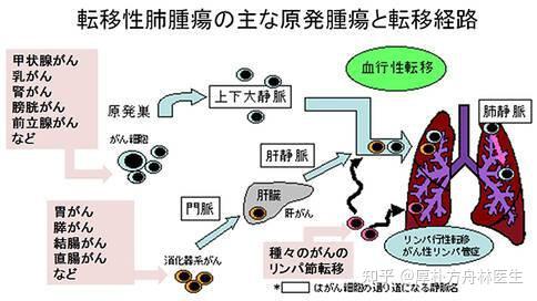 癌症转移到肺部仍可治疗 转移性肺癌治疗方法汇总 知乎