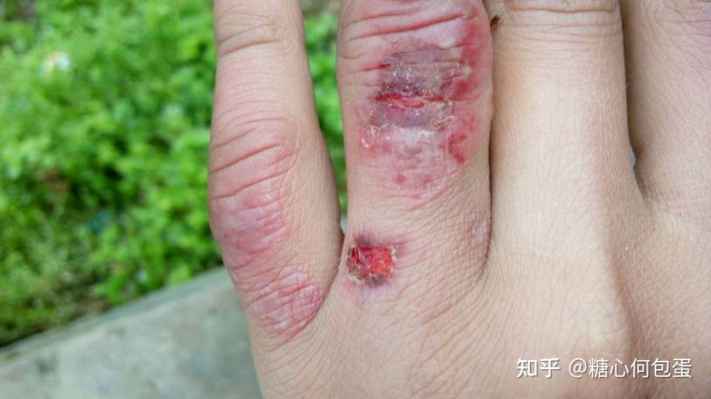 冻疮是什么原理? - 知乎