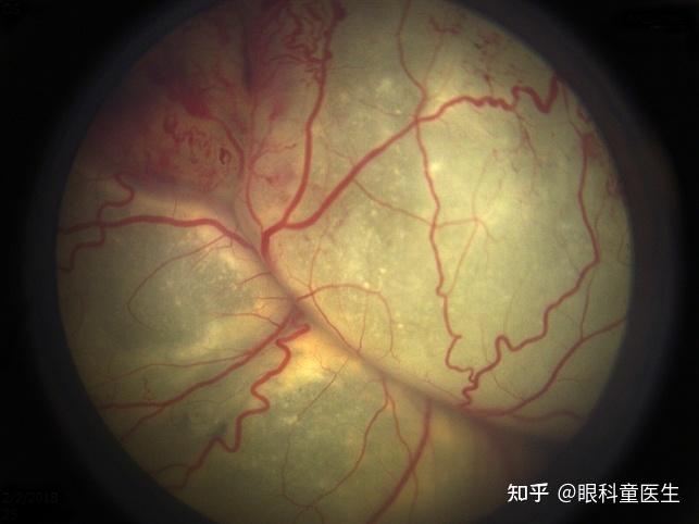 外层渗出性视网膜病变(coats病)