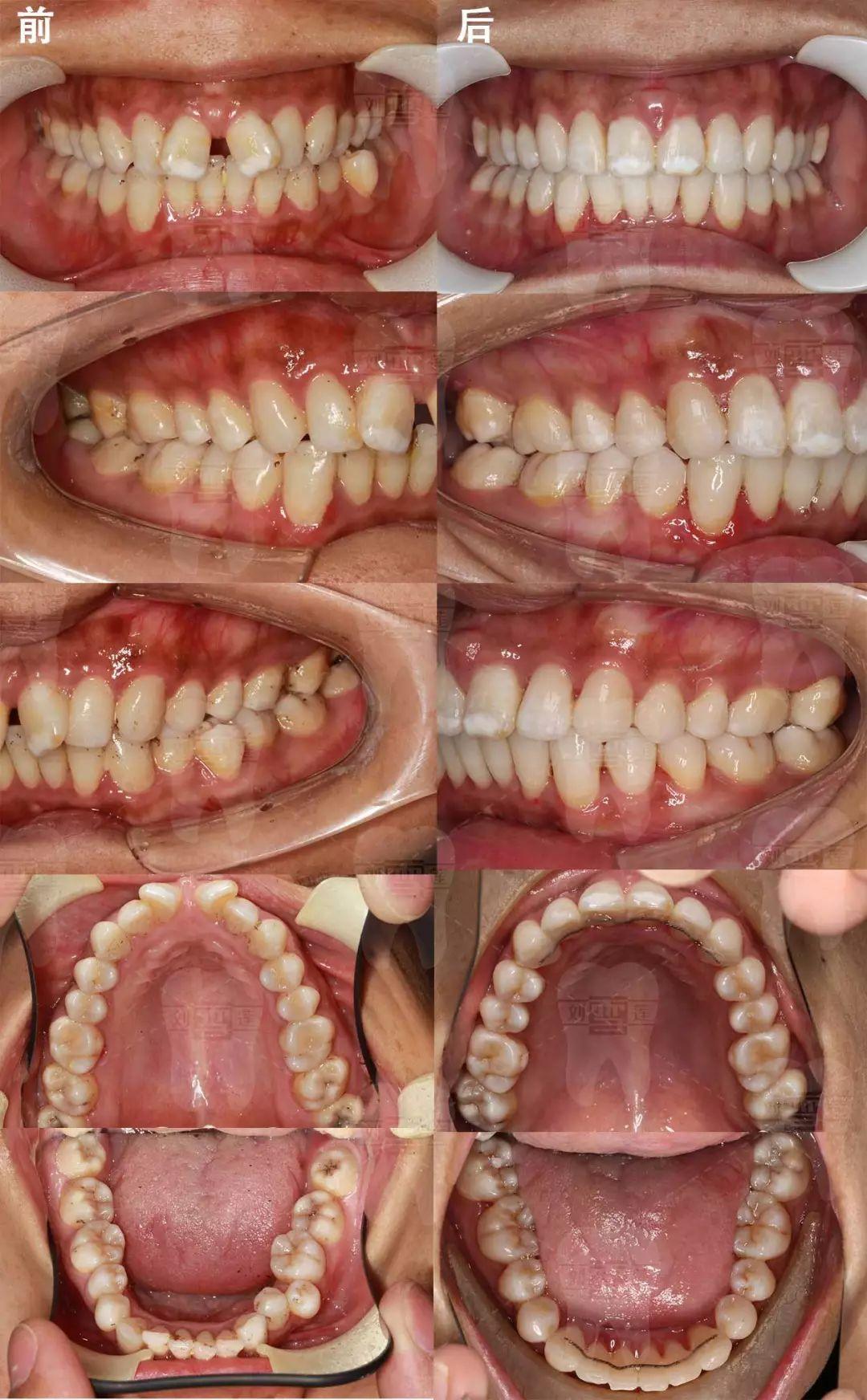 树脂瓷补牙缝好不好,补牙缝树脂补牙,大门牙树脂补牙缝图片(第20页)_大山谷图库