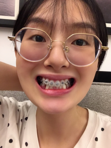 牙套妹看过来测试你属于哪种牙套人格