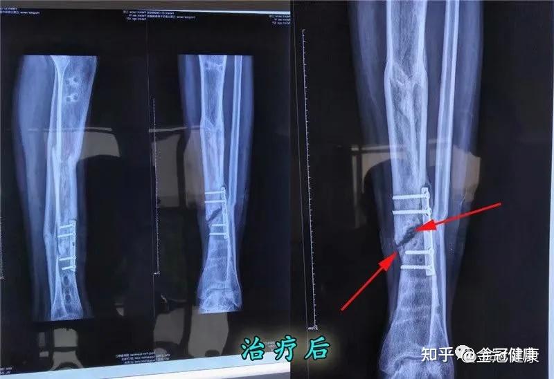 骨不连患者病例介绍附骨不连病因总结