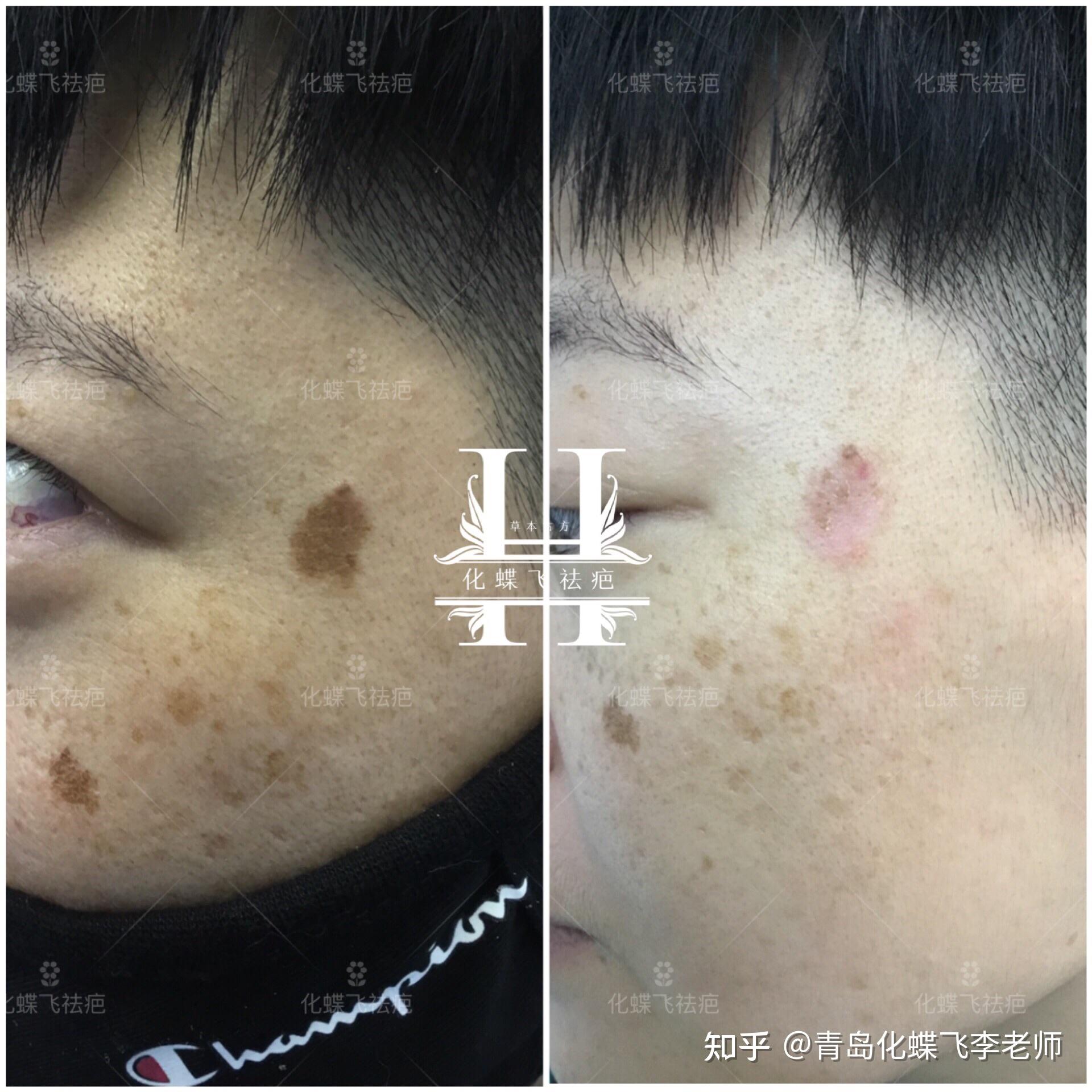 色素疤痕,也叫色素沉淀或色素沉着,无论是烫伤,磕伤,碰伤,摔伤,冻伤留