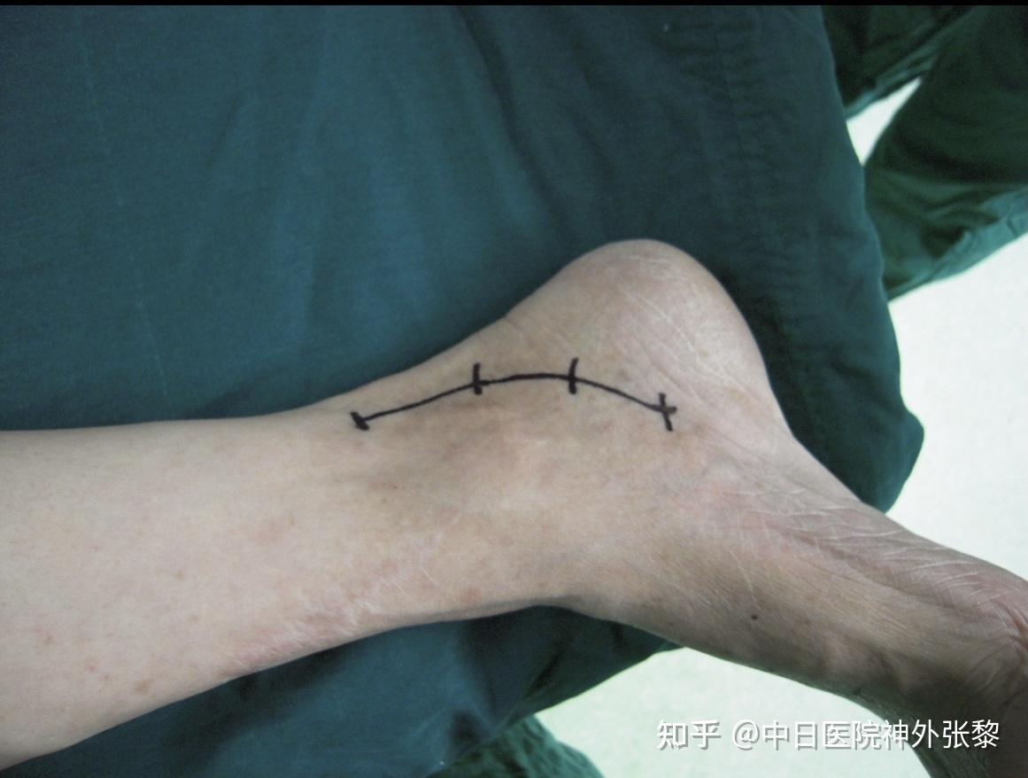 足内踝手术切口中日友好医院神经外科  副主任 张黎 手术中发布于