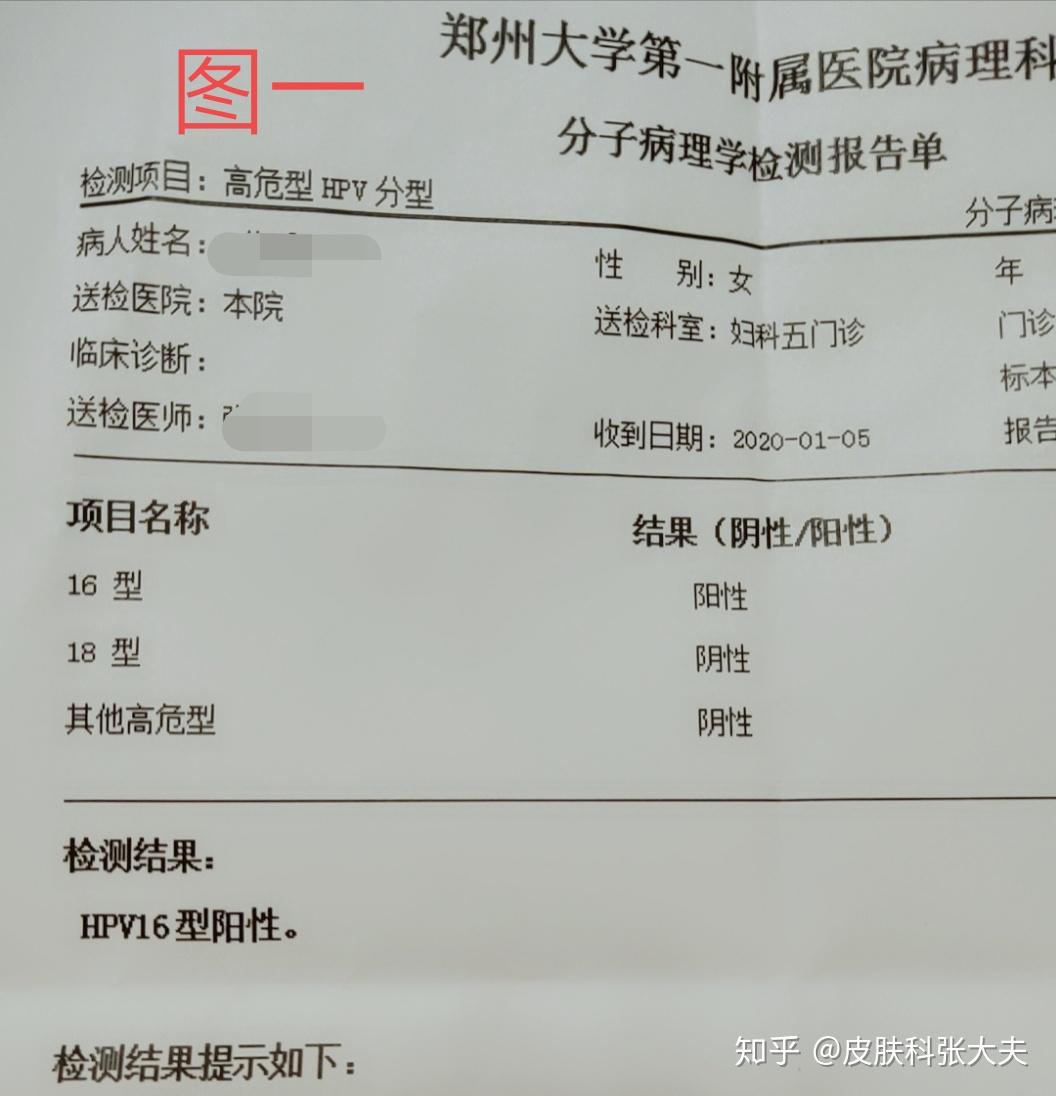 郑州市黄女士hpv16型高危转阴病例分享