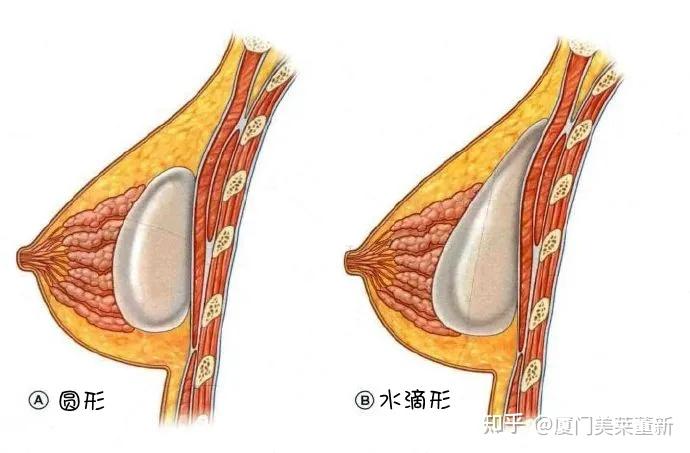 隆胸時配合內窺鏡技術和雙平面技術可以讓豐胸時讓傷口更小,豐胸的