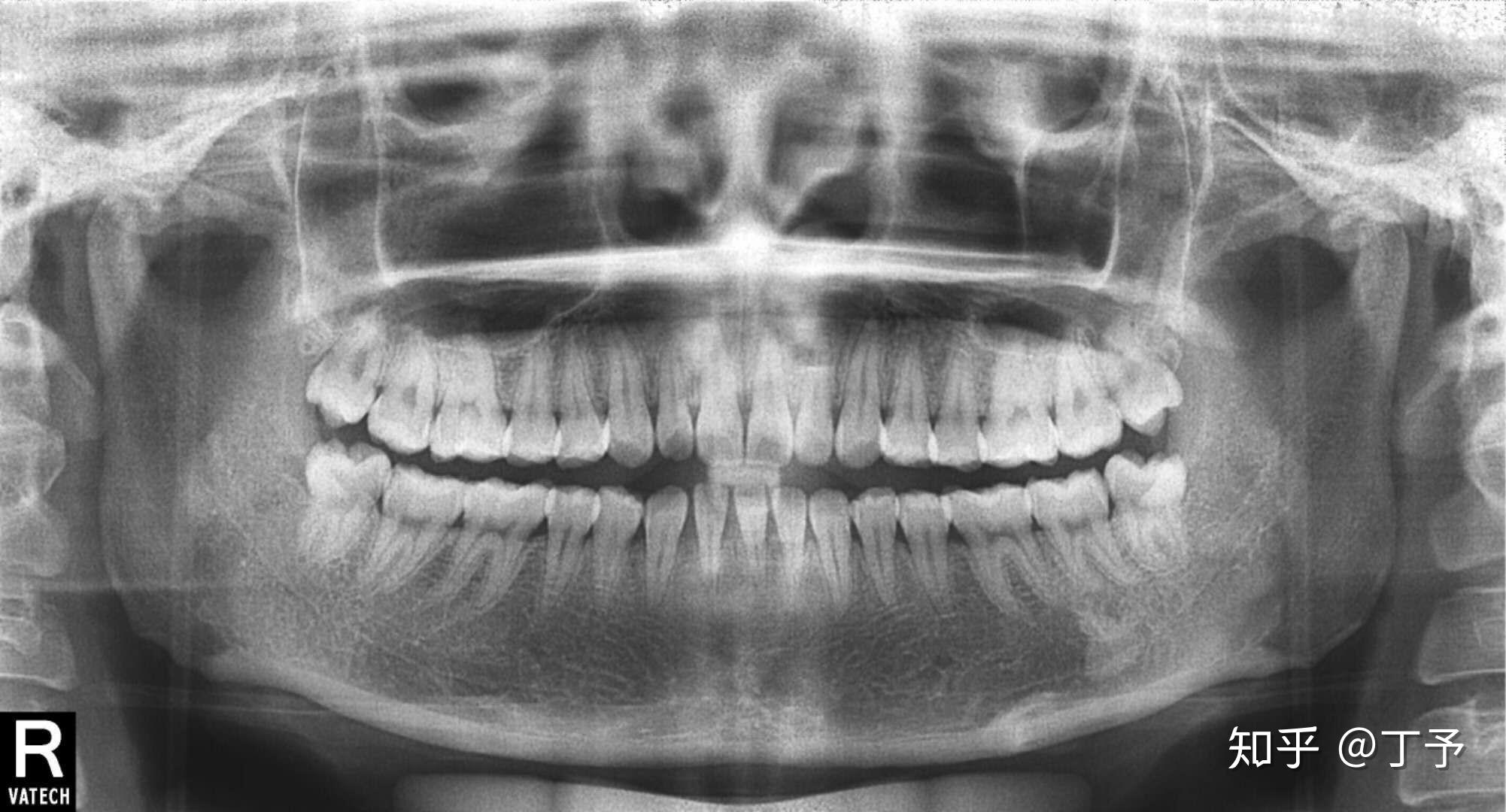 Free Missing teeth Stock Photo - FreeImages.com