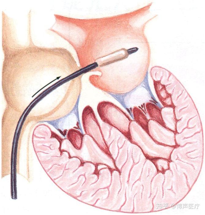 带尖端的球囊导管经过未闭的卵圆孔引入到左房球囊充盈球囊回撤产生