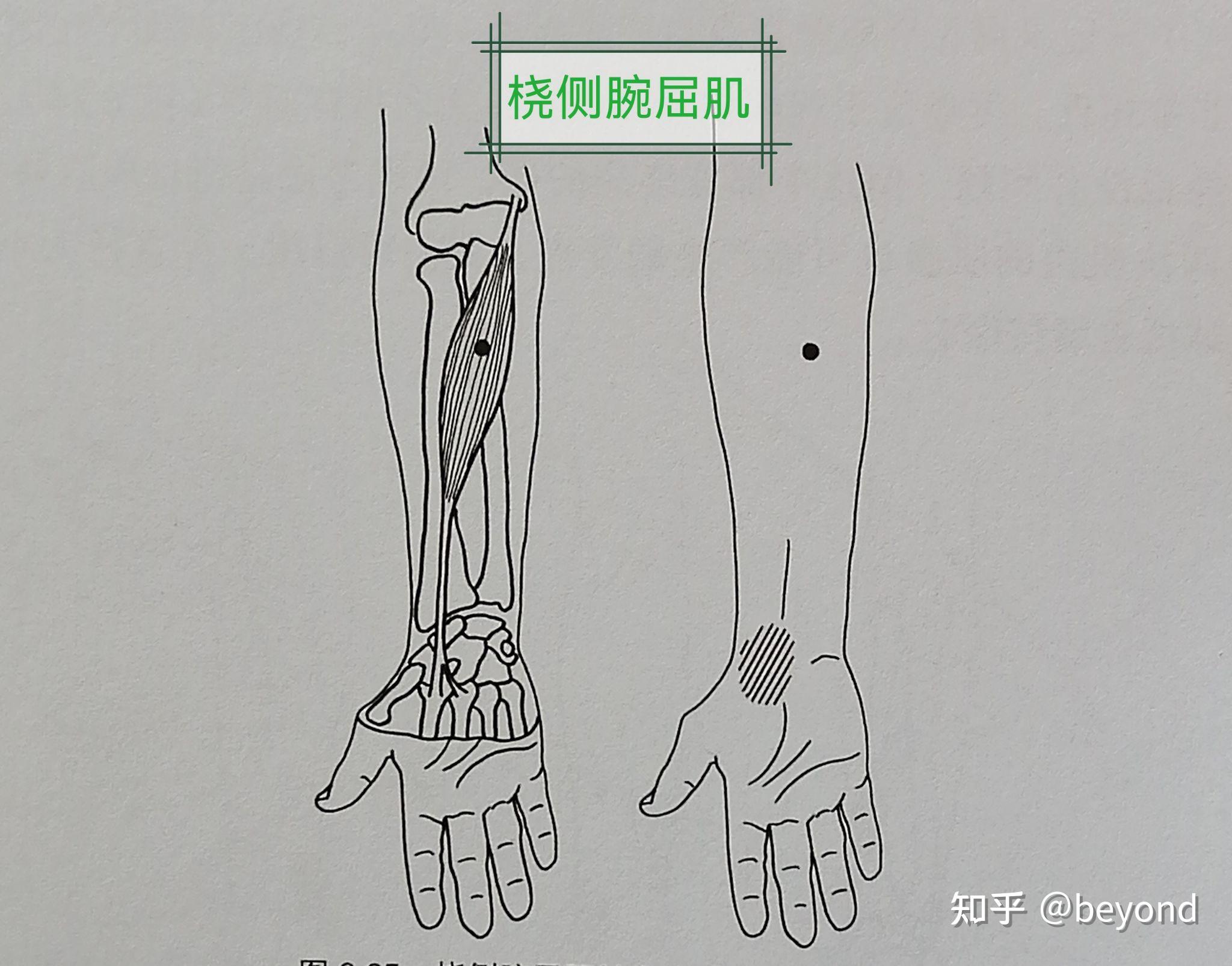 桡侧腕屈肌损伤图片