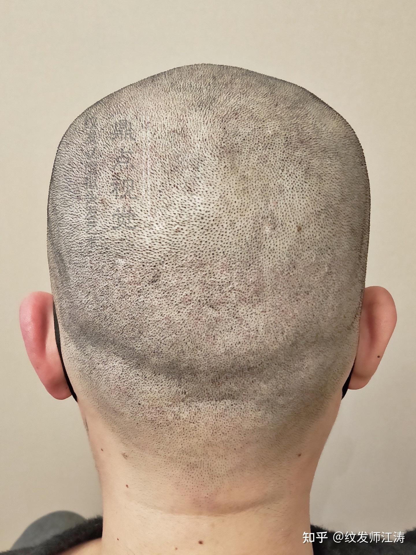 人工植发fue(人工植发技术成熟吗)