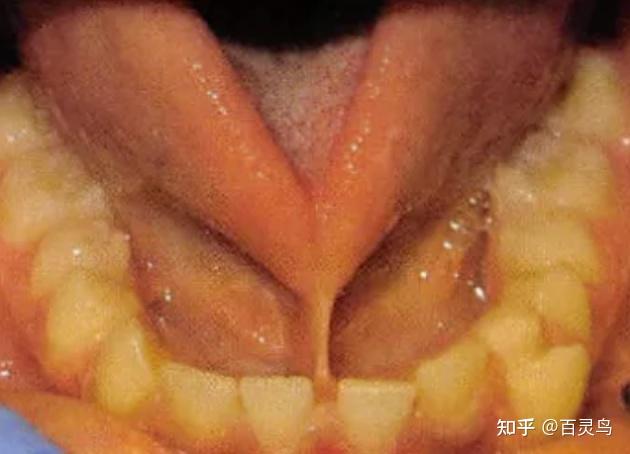 2,很难抬起舌头碰到上门牙;1,往前伸舌头时,没法超过下门牙,舌尖会