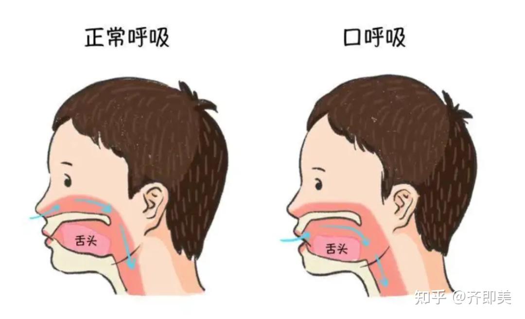 儿牙健康 | 如何纠正儿童不良吐舌习惯? - 知乎