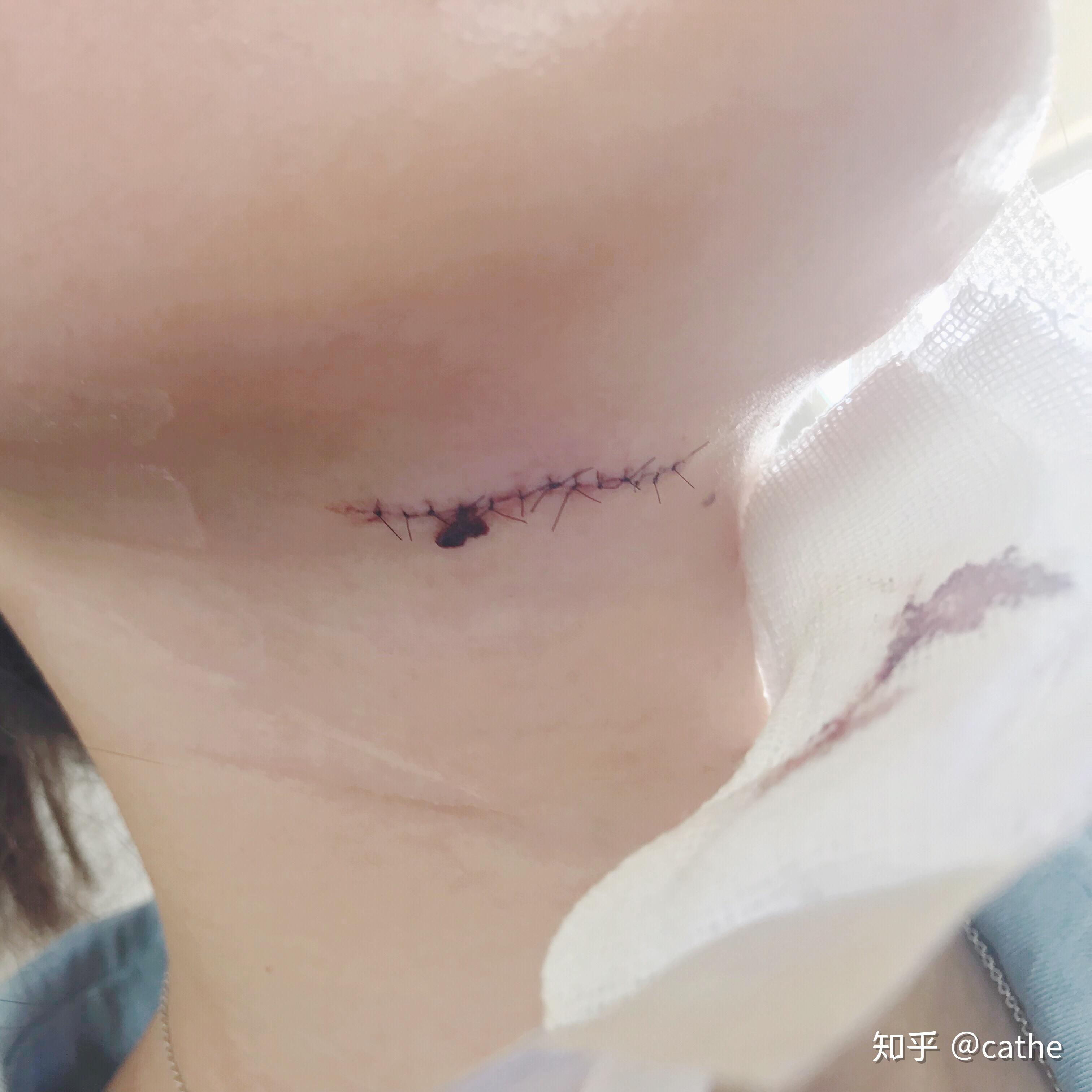 手术切痣是一种怎样的体验?