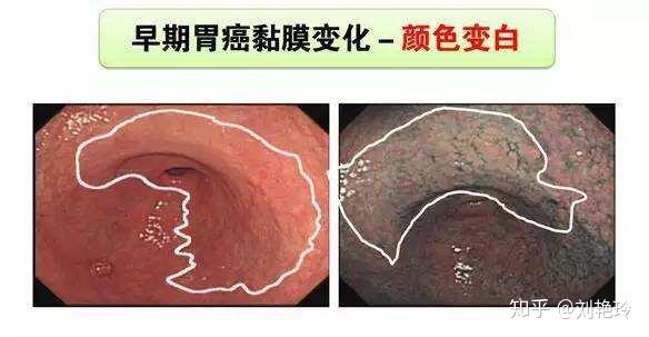 胃癌早期症状并不明显如想发现早期胃癌出现这些症状不要硬扛