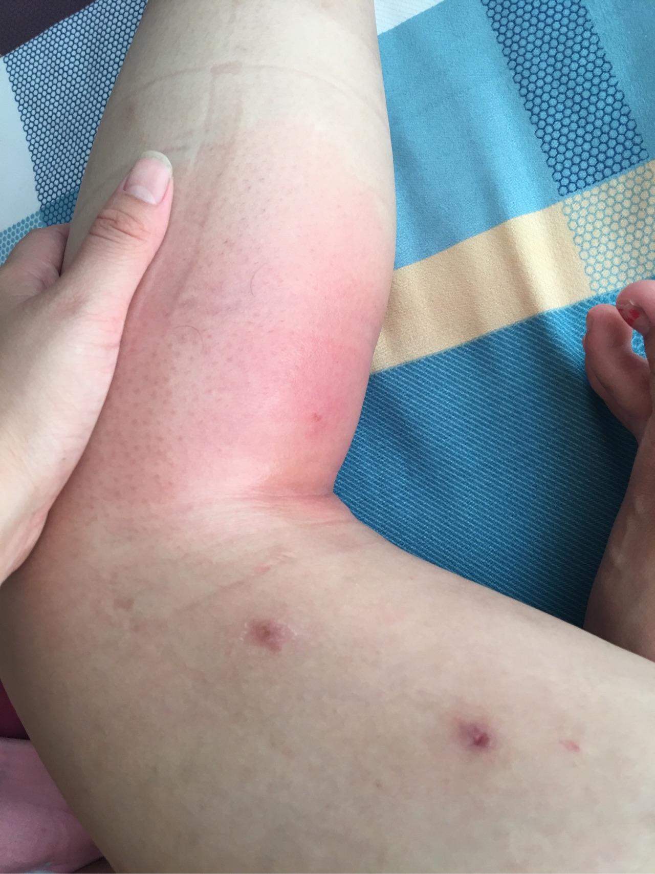 对蚊子过敏怎么办