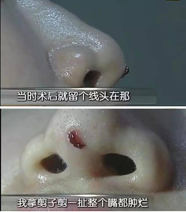 正规医院和机构拒绝做线雕隆鼻网友好可怕