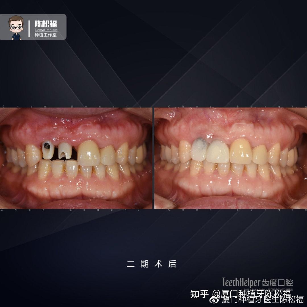 厦门种植牙 | 案例分享-唇侧BGR术提升种植美学效果 - 知乎