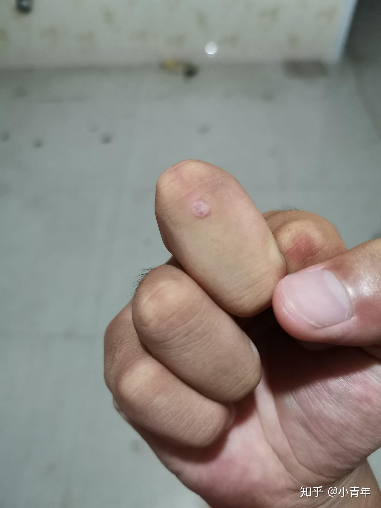 手指上起了几个刺瘊应该用什么药物治疗呢求解答