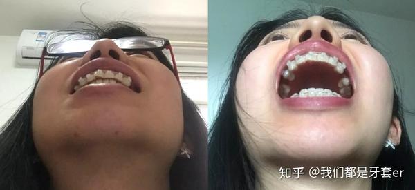 案例分享 | 牙性 骨性龅牙 嘴突 下巴后缩,没打骨钉但效果很满意,还