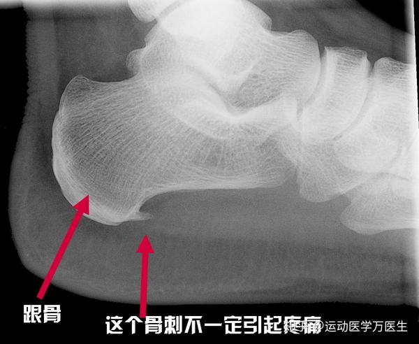 跟骨解剖细节图谱 x线图片