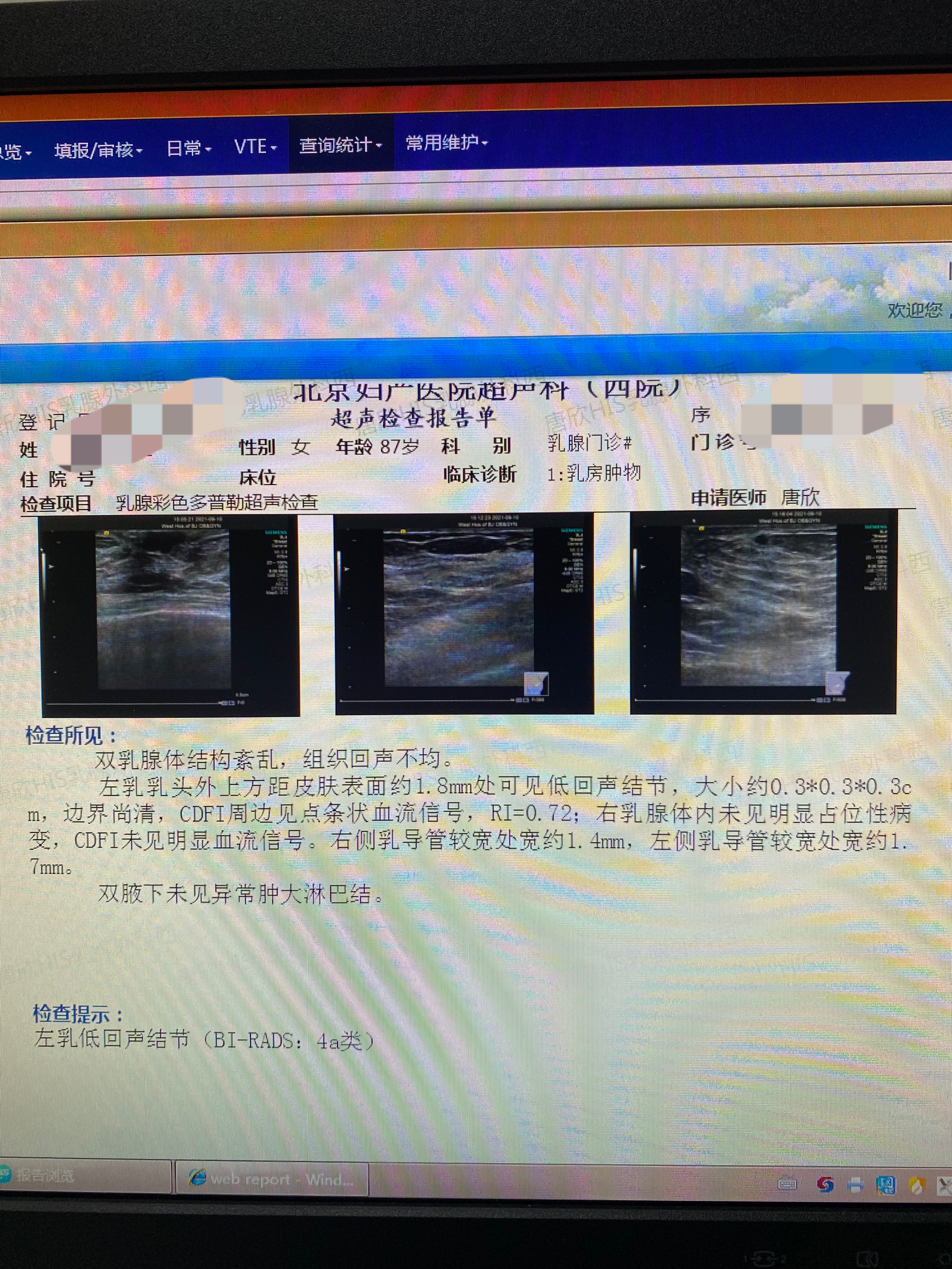 乳腺微小结节,是否需要手术?