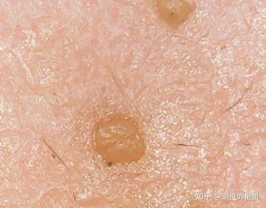 脂质微丝到底是什么