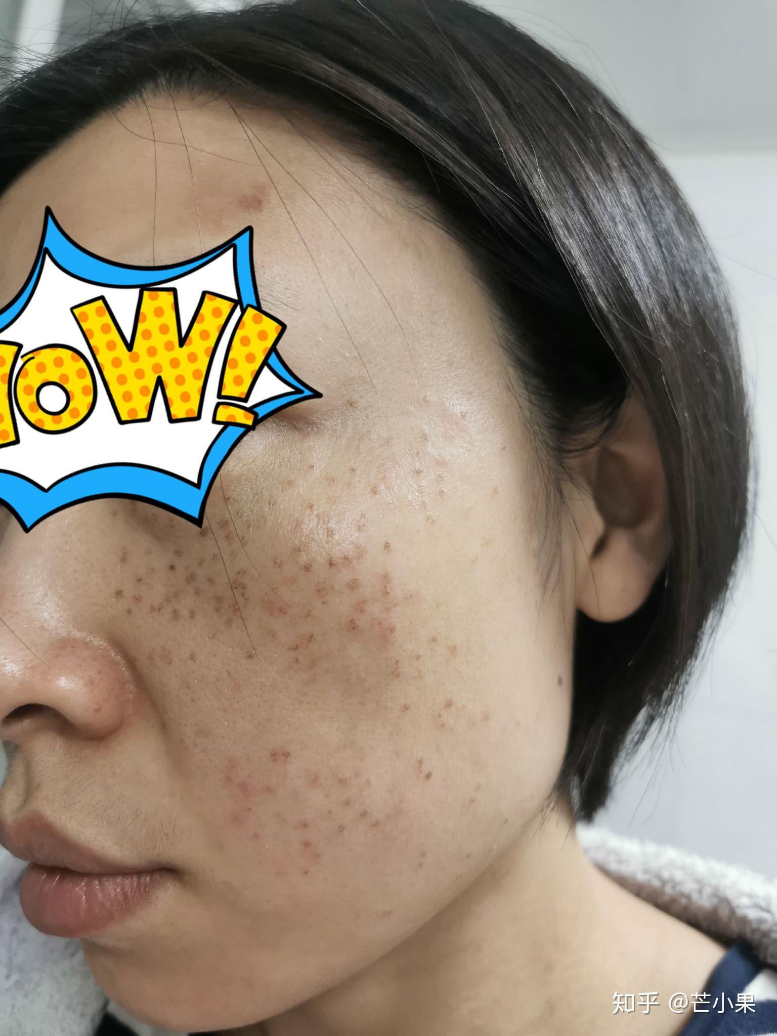 蜂巢皮秒超皮秒全过程记录