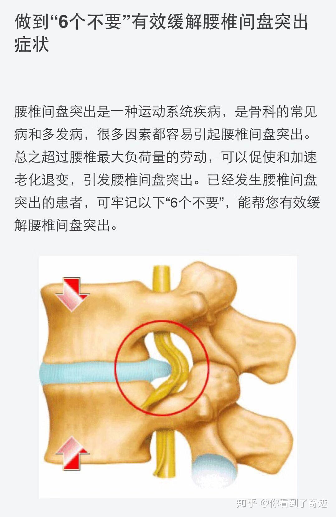 做到6个不要有效缓解腰椎间盘突出症状