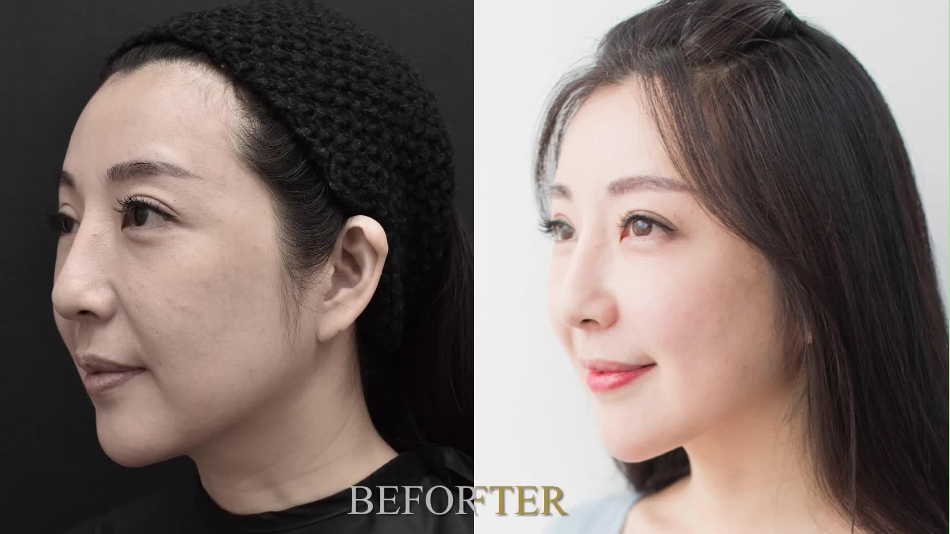 自体脂肪填充苹果肌,两边脸会吸收的不一样吗?一般情况下是不是都需要