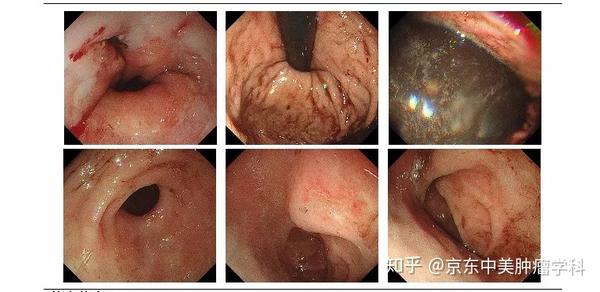 吐 出来的毛病 贲门黏膜撕裂综合征 知乎