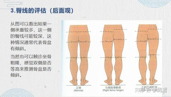长短腿?你的骨盆已经"侧倾"!