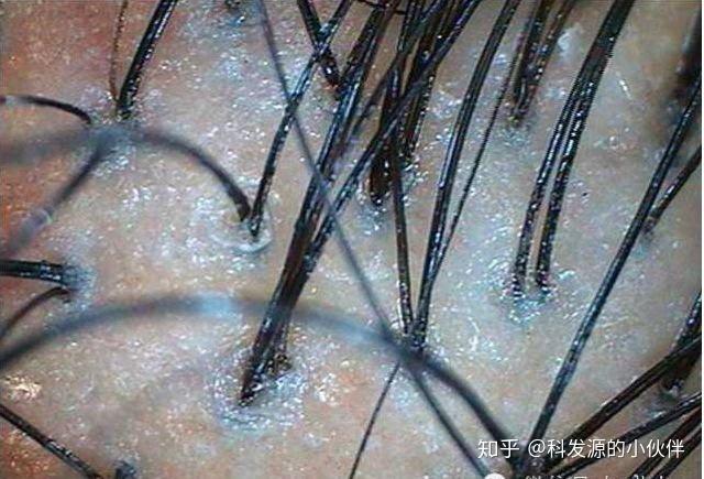 毛囊会死吗脱发时间长还能治好吗