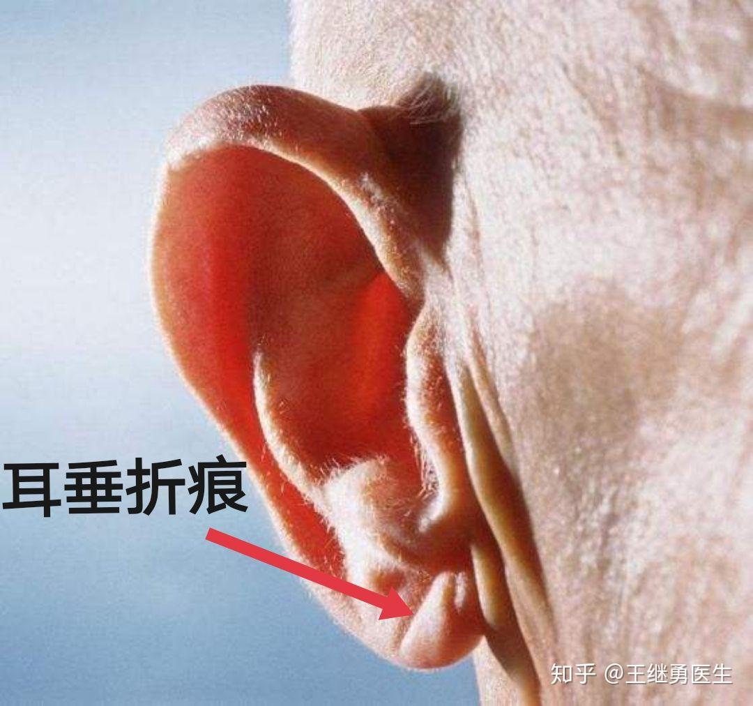 额秃(发际线后移),头顶秃,耳垂折痕,耳前折痕,眼袋深,鱼尾纹深,额头