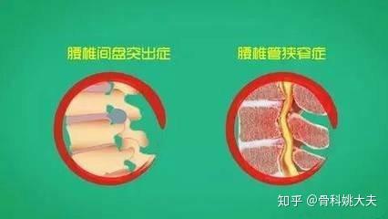 腰椎间管狭窄症怎么办 腰椎管狭窄的治疗方法 你都知道吗 知乎