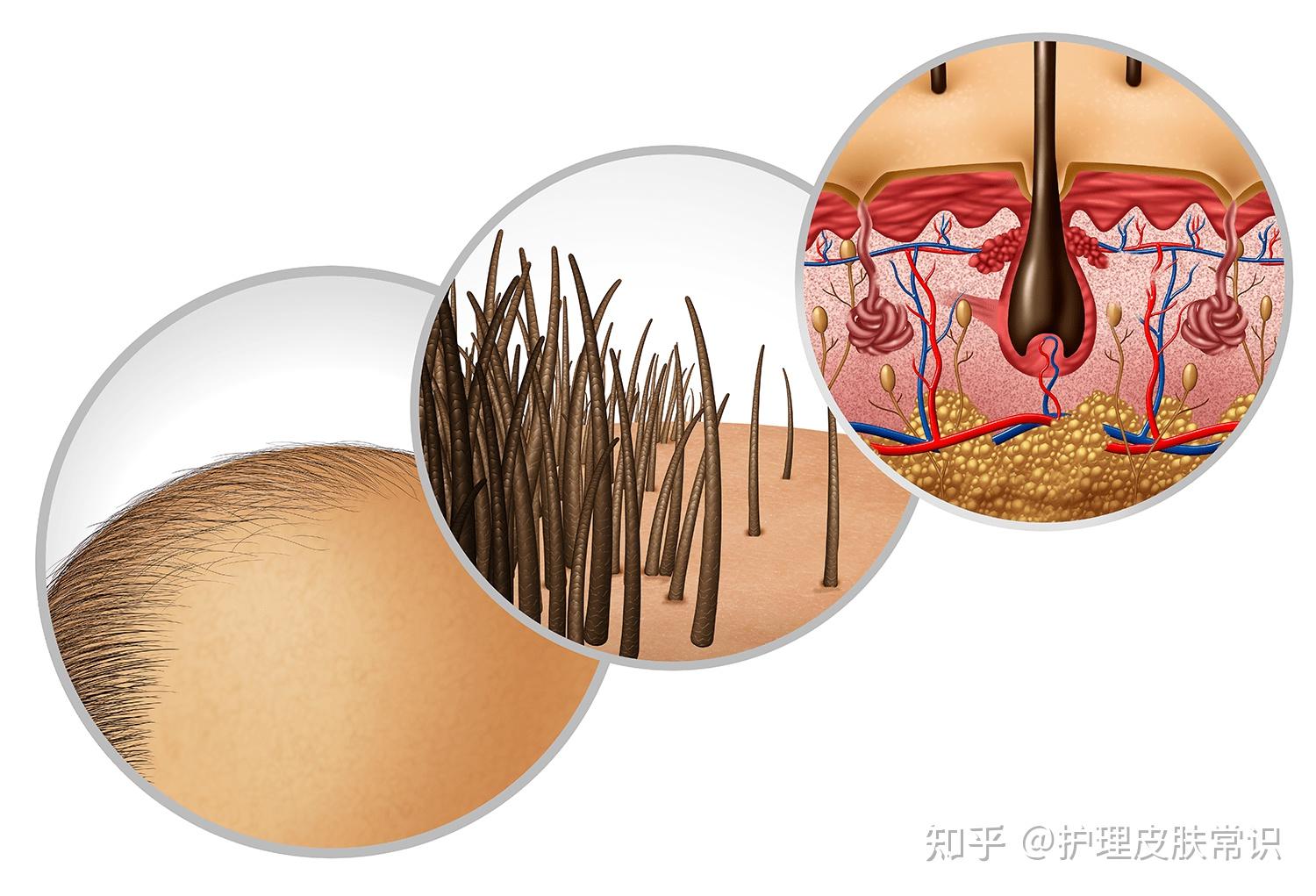 马拉色菌毛囊炎的治疗史 - 知乎