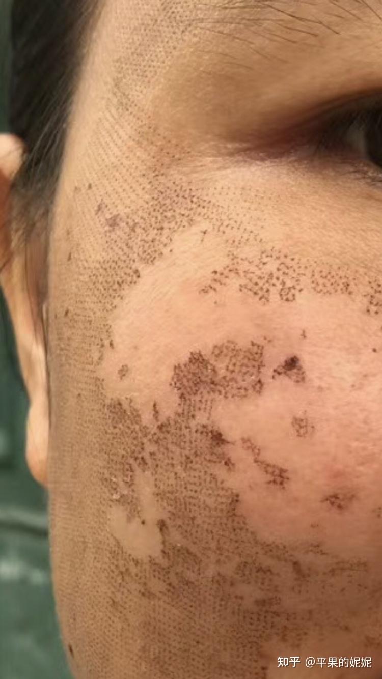 做点阵激光去黄效果明显