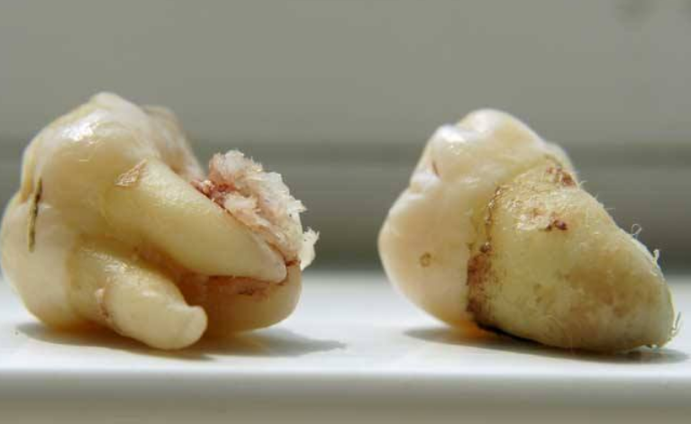 【修正数字口腔】单侧牙咀嚼可能会带来这些危害哦