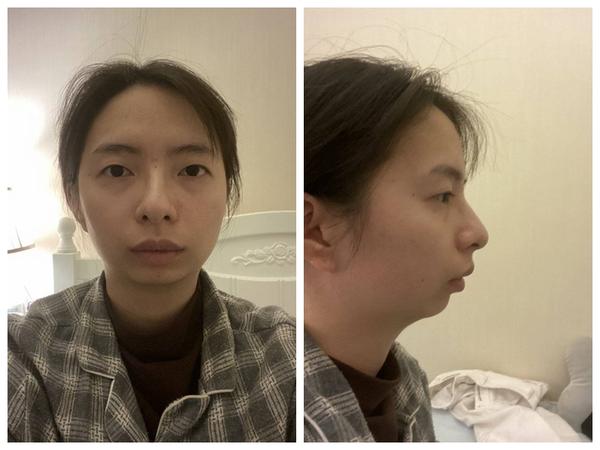 下巴后缩怎么办？有什么办法可以改善？如何判断自己是否下巴后缩…