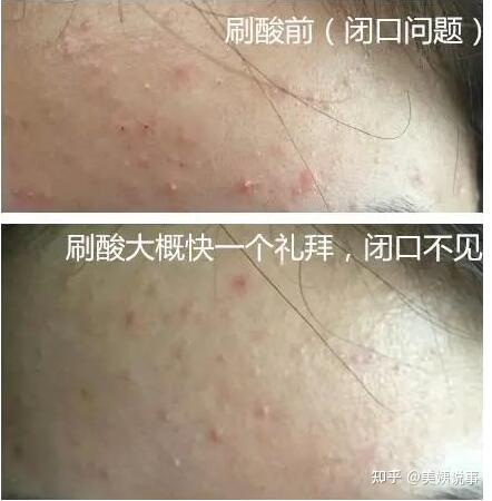 高浓度刷酸鸡皮肤(高浓度刷酸鸡皮肤有用吗)