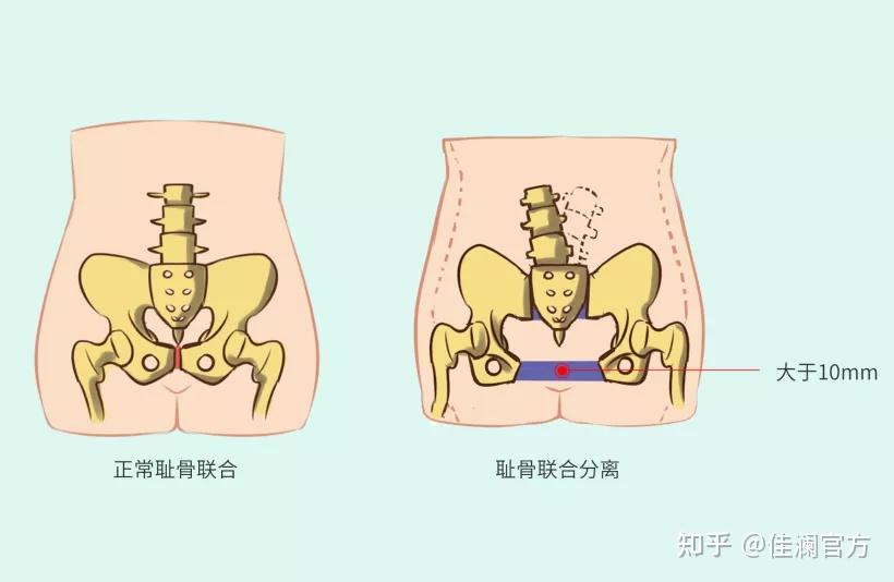 當恥骨聯合距離增寬超過10mm或上下錯動而出現局部疼痛和下肢抬舉困難