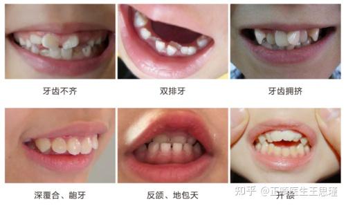 小朋友牙齿不齐矫正的三个黄金期宝爸宝妈们一定要知道